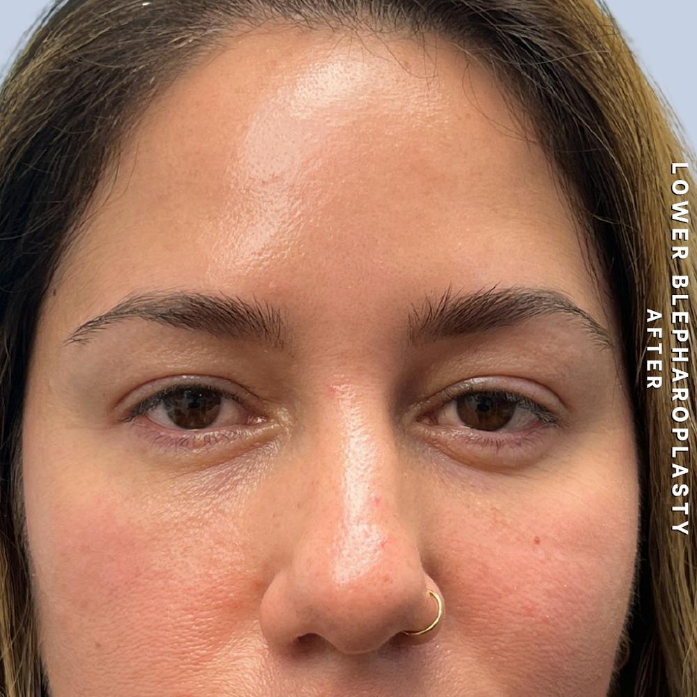 Eyes Before & After Gallery - Patient 334375 - Image 6