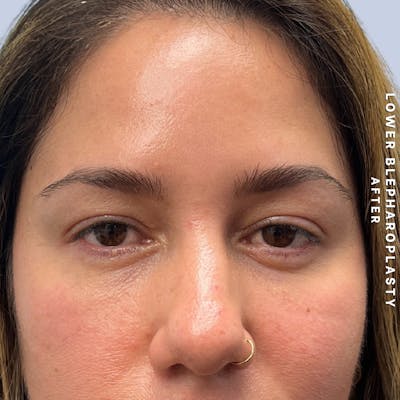 Eyes Before & After Gallery - Patient 334375 - Image 6