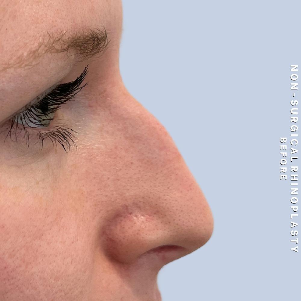 Non-Surgical Nose Before & After Gallery - Patient 400517 - Image 1