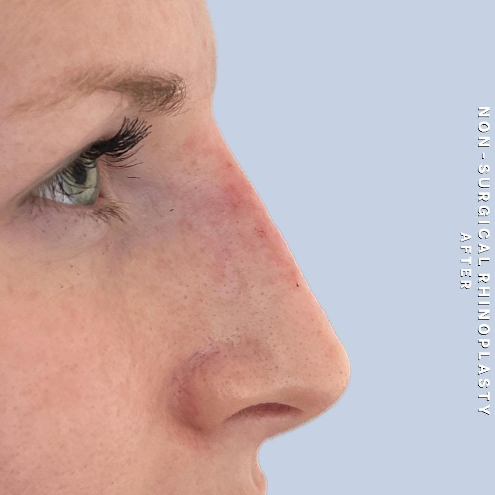 Non-Surgical Nose Before & After Gallery - Patient 400517 - Image 2