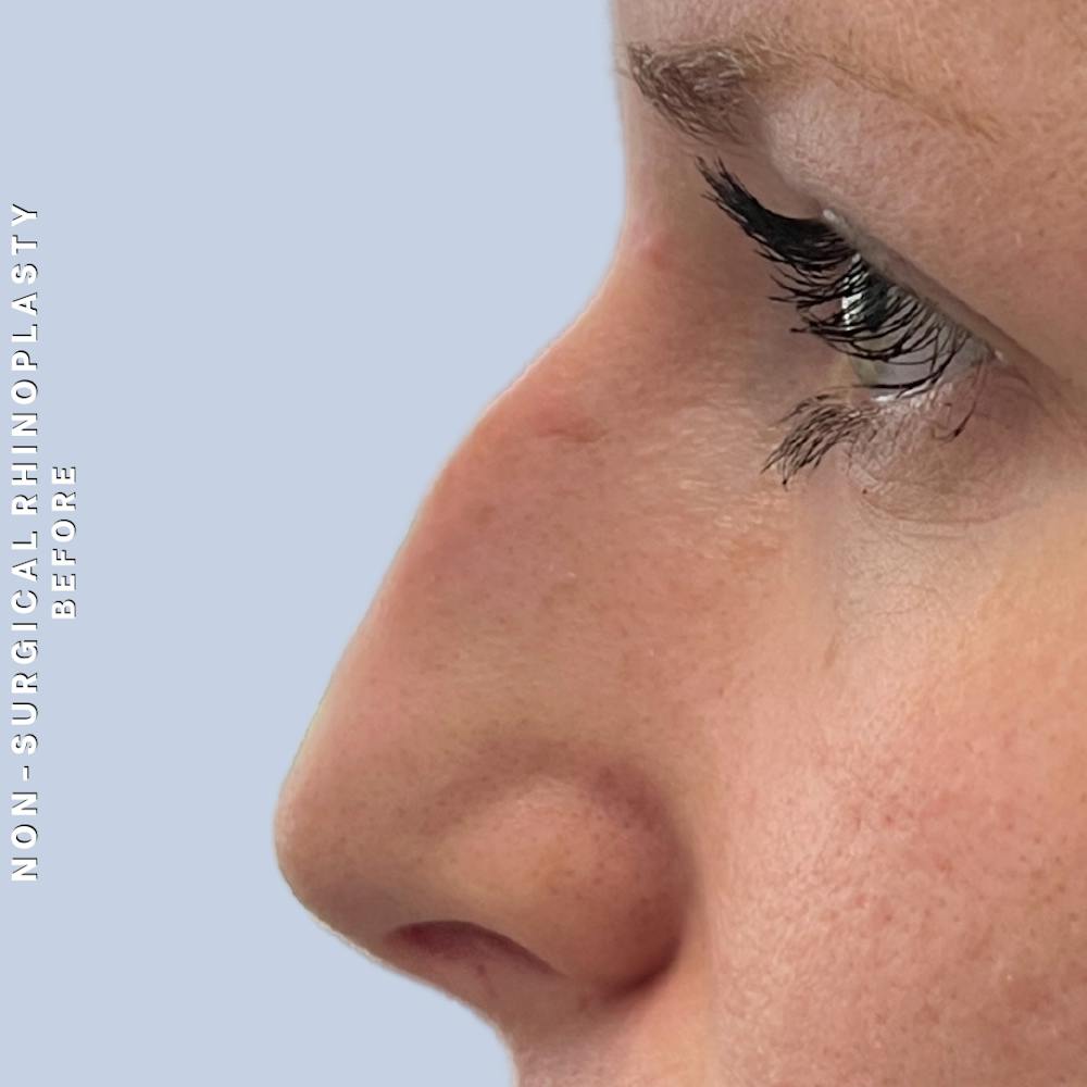 Non-Surgical Nose Before & After Gallery - Patient 400517 - Image 3