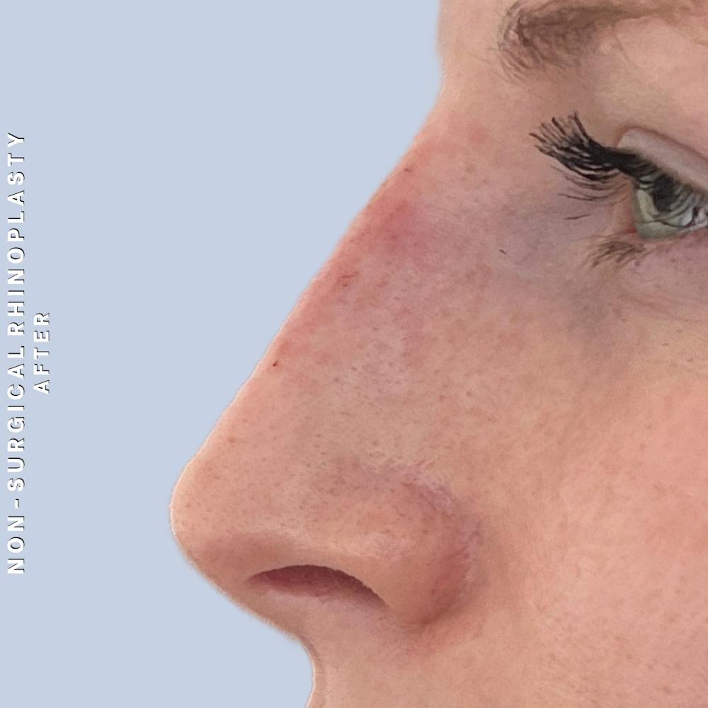 Non-Surgical Nose Before & After Gallery - Patient 400517 - Image 4