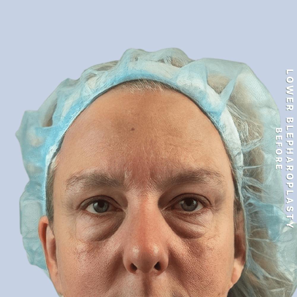 Eyes Before & After Gallery - Patient 227892 - Image 1
