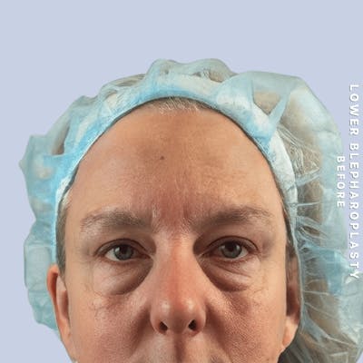 Eyes Before & After Gallery - Patient 227892 - Image 1