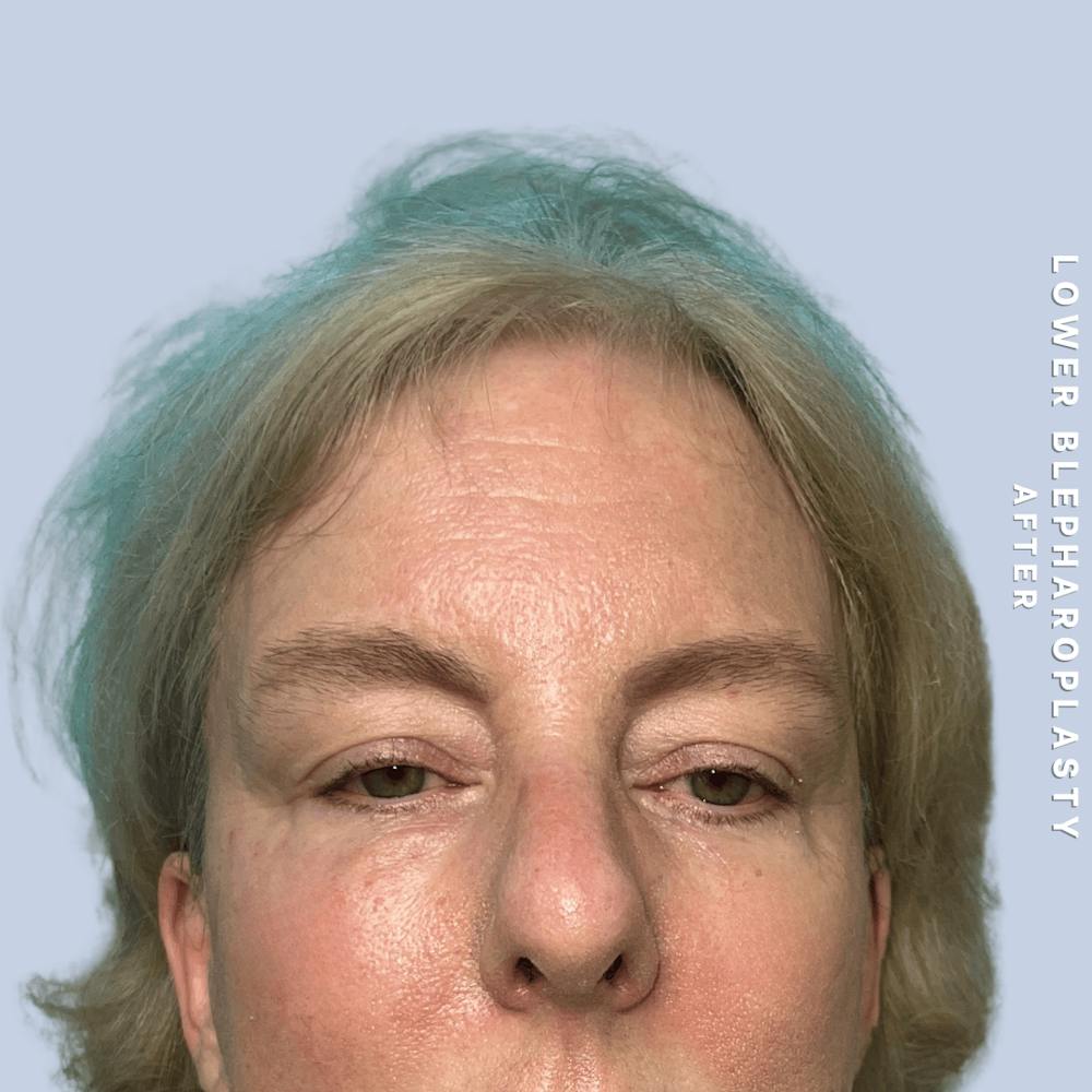 Eyes Before & After Gallery - Patient 227892 - Image 2