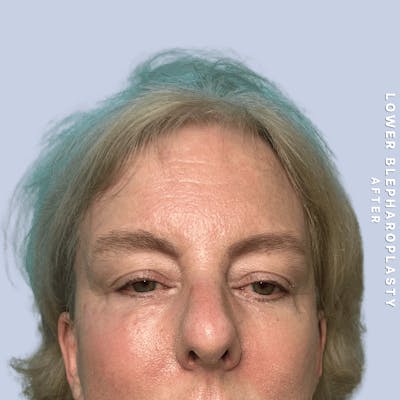 Eyes Before & After Gallery - Patient 227892 - Image 2