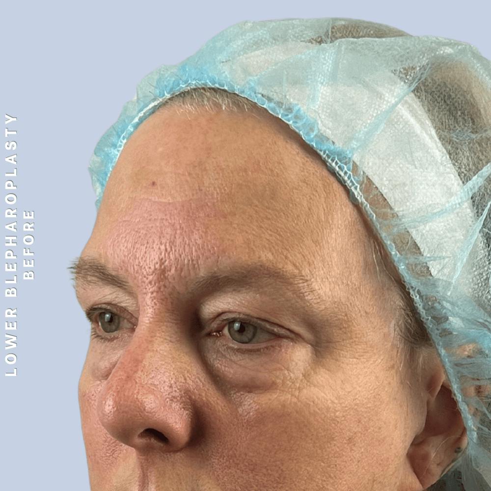 Eyes Before & After Gallery - Patient 227892 - Image 3