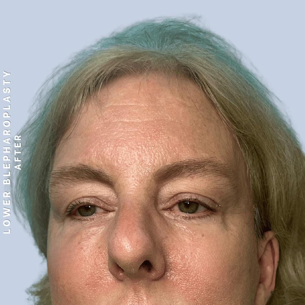 Eyes Before & After Gallery - Patient 227892 - Image 4