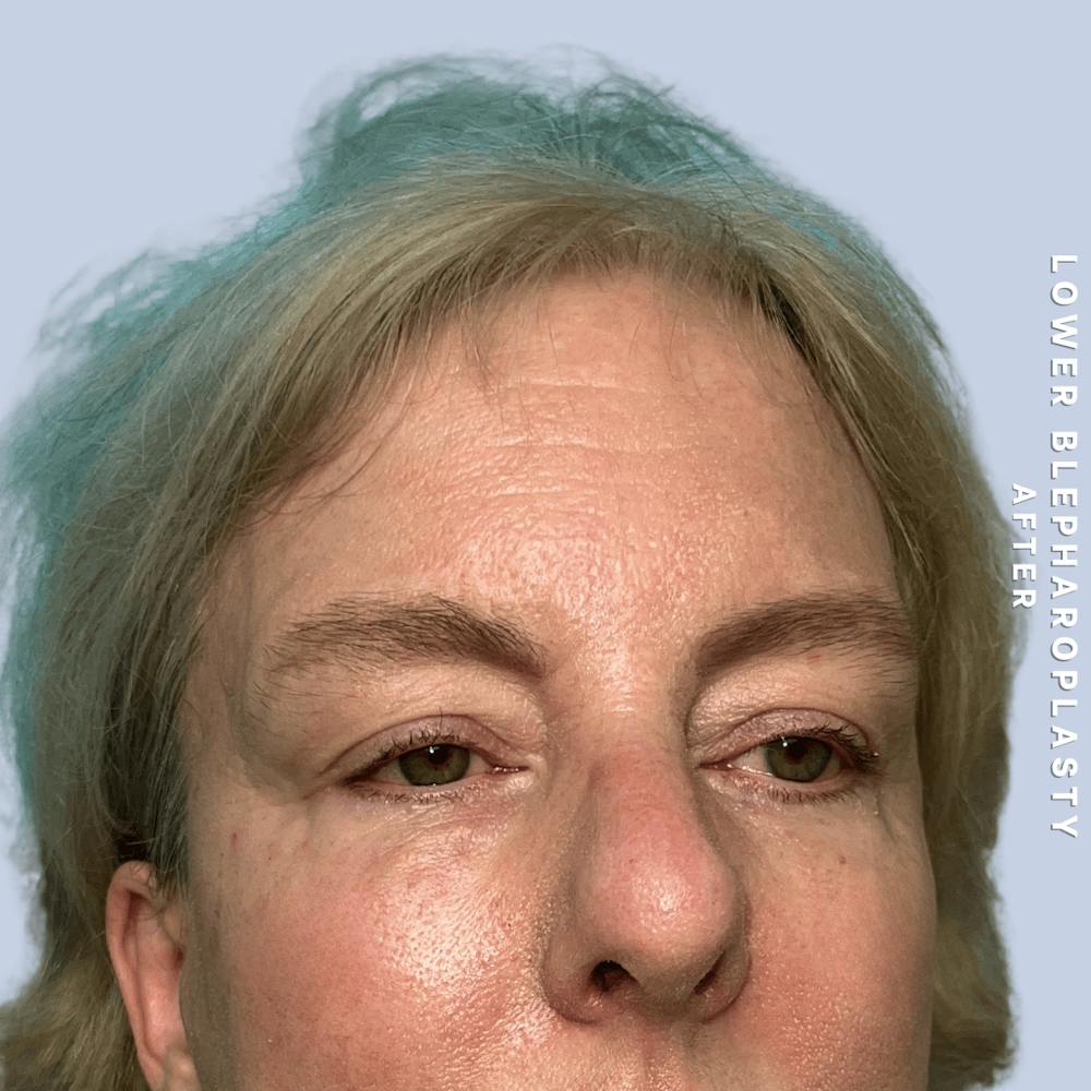 Eyes Before & After Gallery - Patient 227892 - Image 6