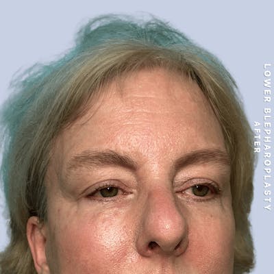 Eyes Before & After Gallery - Patient 227892 - Image 6