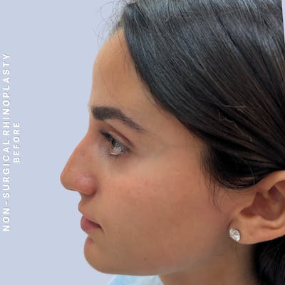 Non-Surgical Nose Before & After Gallery - Patient 102936 - Image 1