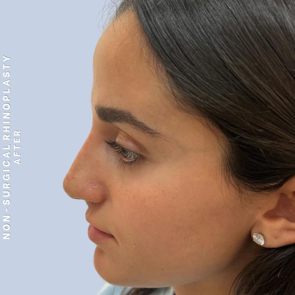 Non-Surgical Nose Before & After Gallery - Patient 102936 - Image 2