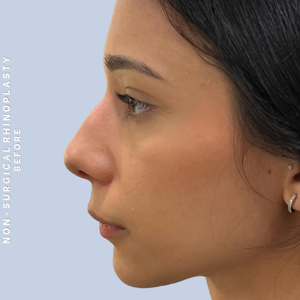 Non-Surgical Nose Before & After Gallery - Patient 196701 - Image 3