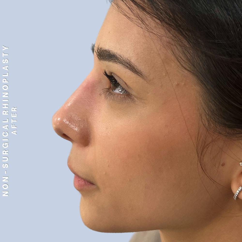 Non-Surgical Nose Before & After Gallery - Patient 196701 - Image 4
