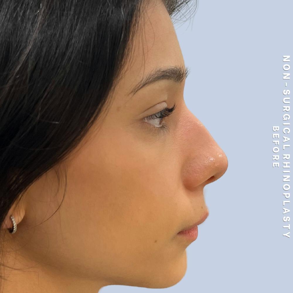 Non-Surgical Nose Before & After Gallery - Patient 196701 - Image 1