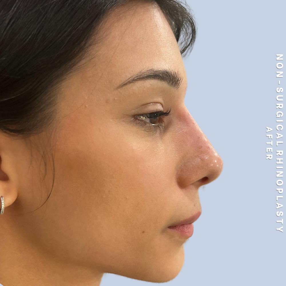 Non-Surgical Nose Before & After Gallery - Patient 196701 - Image 2