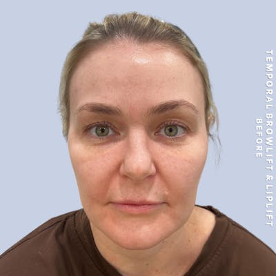 Eyes Before & After Gallery - Patient 328572 - Image 1