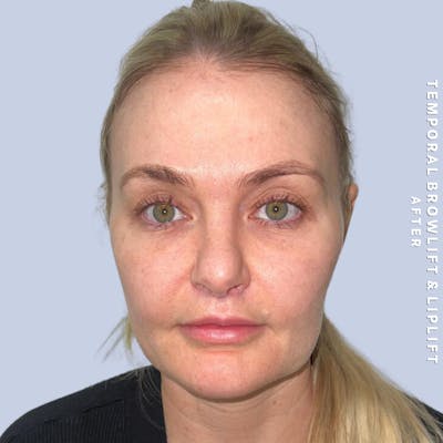 Eyes Before & After Gallery - Patient 328572 - Image 2