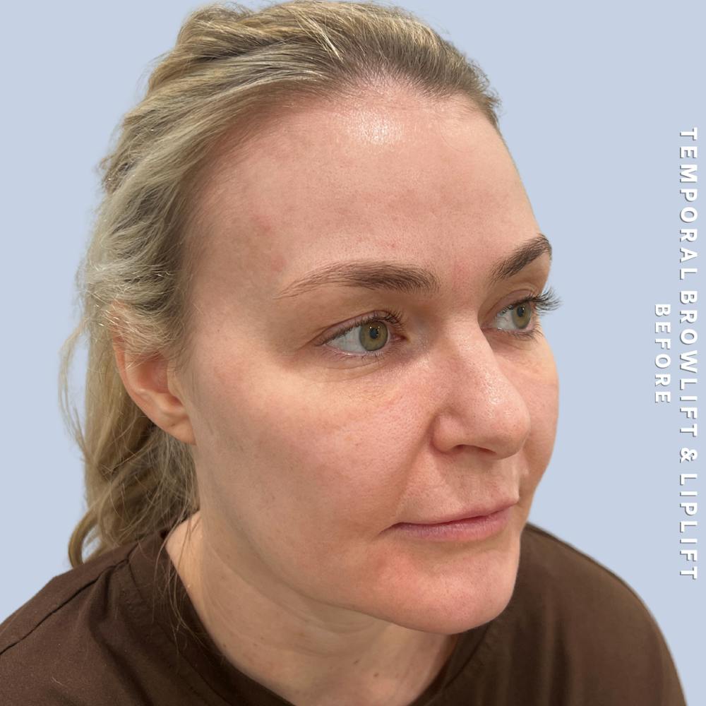 Eyes Before & After Gallery - Patient 328572 - Image 3