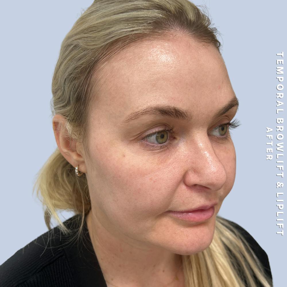 Eyes Before & After Gallery - Patient 328572 - Image 4