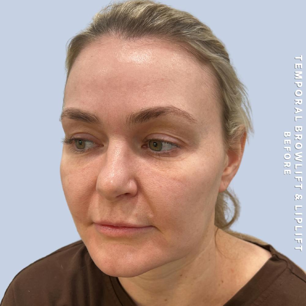 Eyes Before & After Gallery - Patient 328572 - Image 5