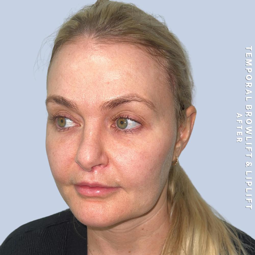 Eyes Before & After Gallery - Patient 328572 - Image 6