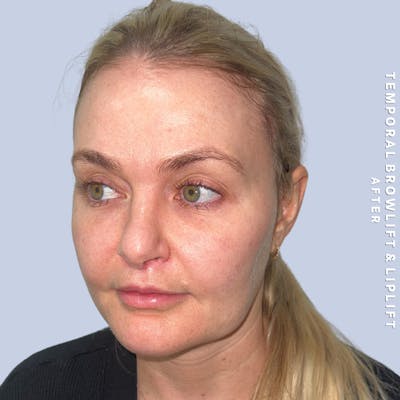 Eyes Before & After Gallery - Patient 328572 - Image 6