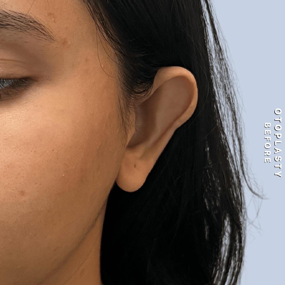 Ears Before & After Gallery - Patient 196133 - Image 1