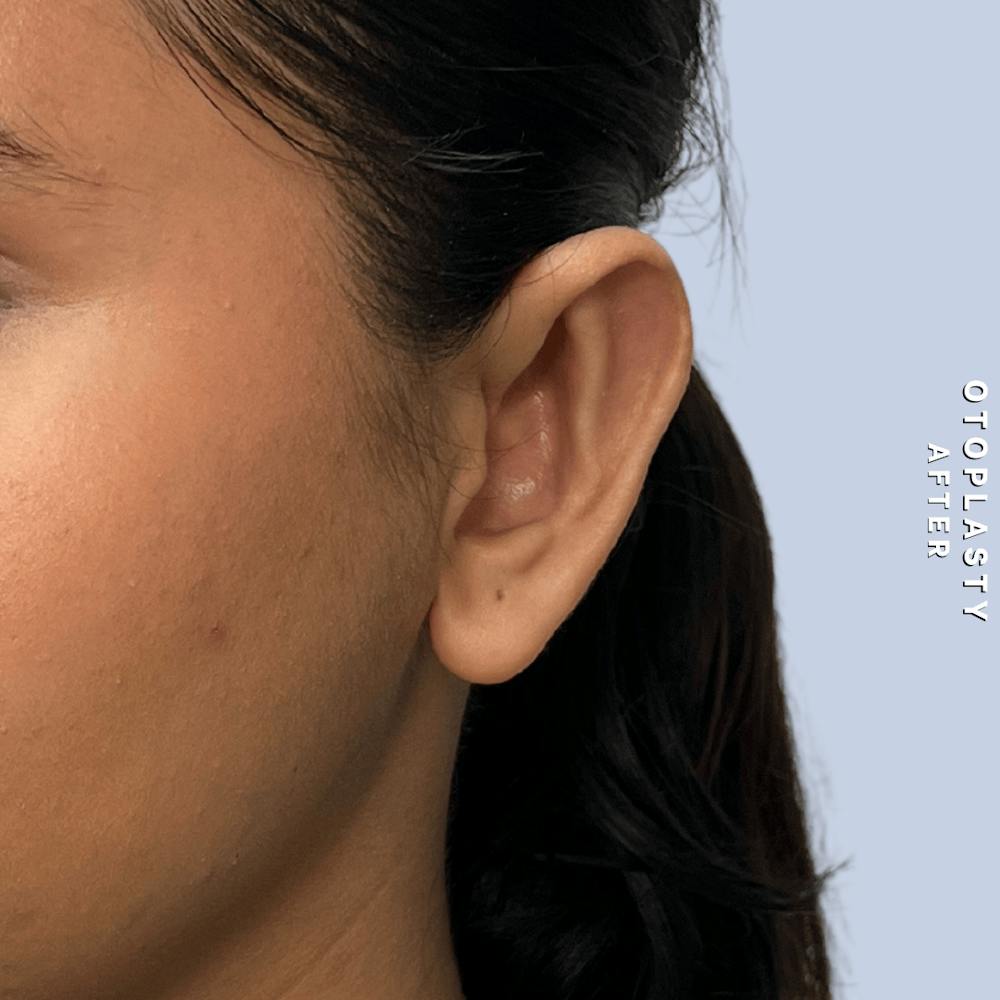 Ears Before & After Gallery - Patient 196133 - Image 2