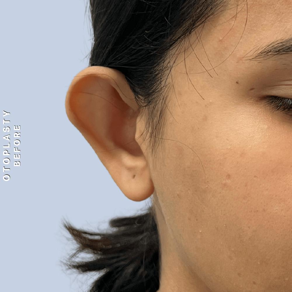 Ears Before & After Gallery - Patient 196133 - Image 3
