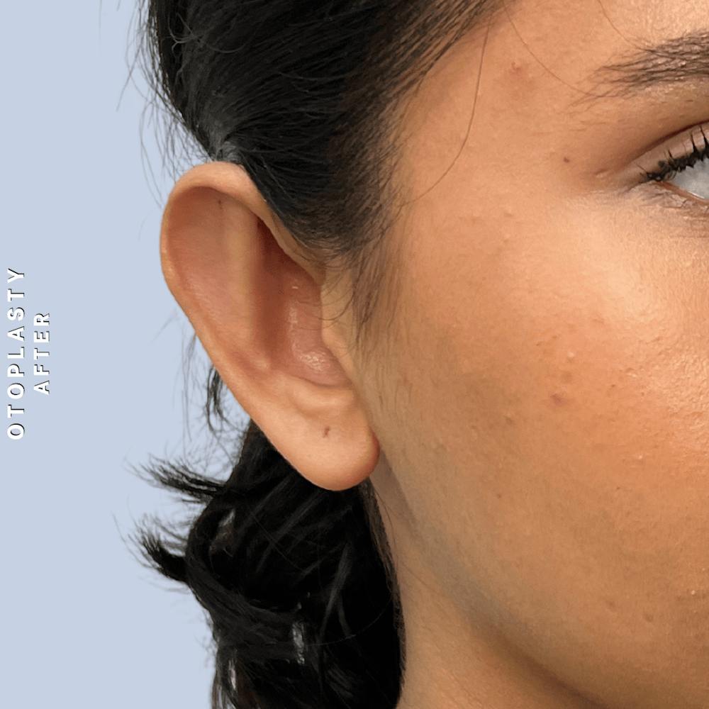 Ears Before & After Gallery - Patient 196133 - Image 4