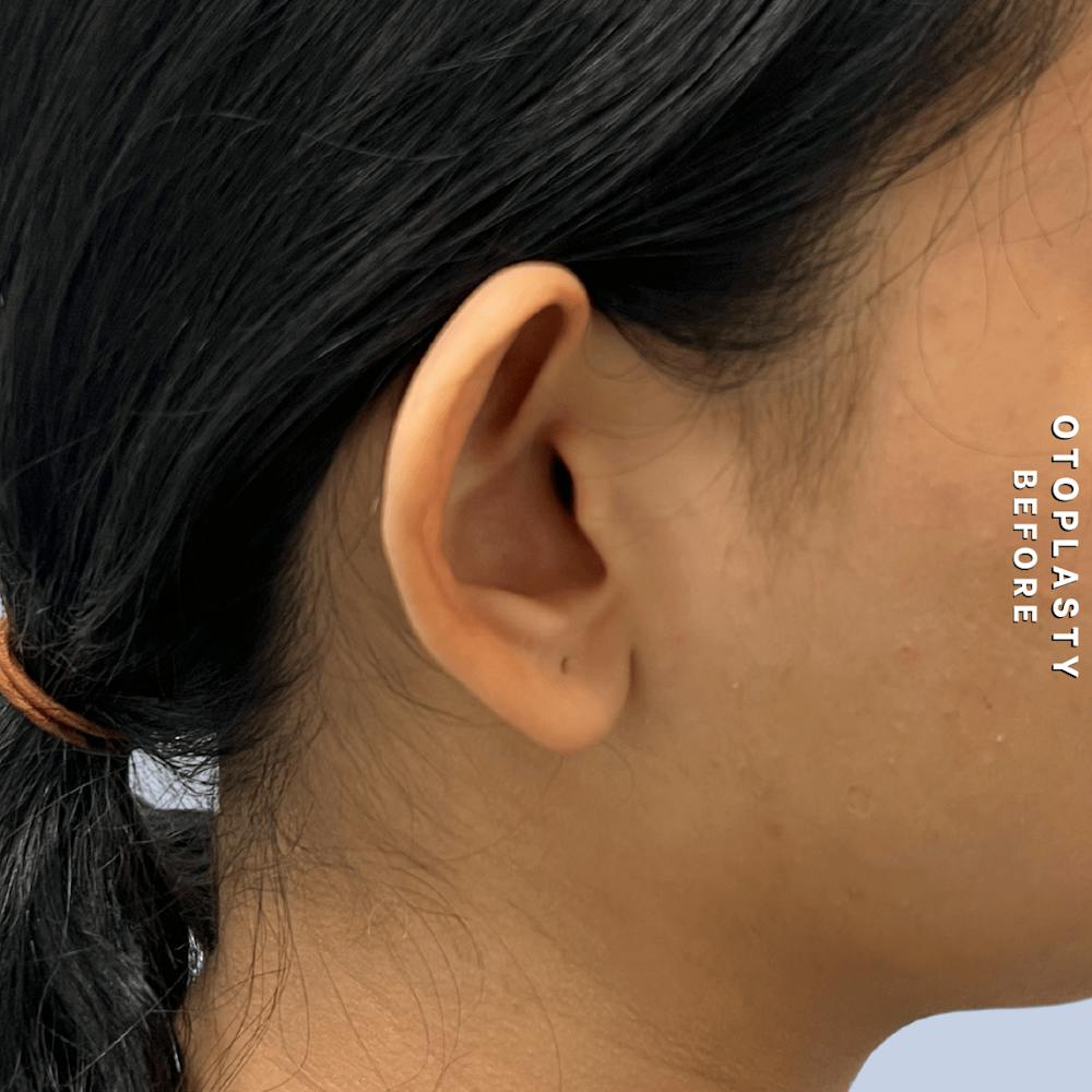 Ears Before & After Gallery - Patient 196133 - Image 5