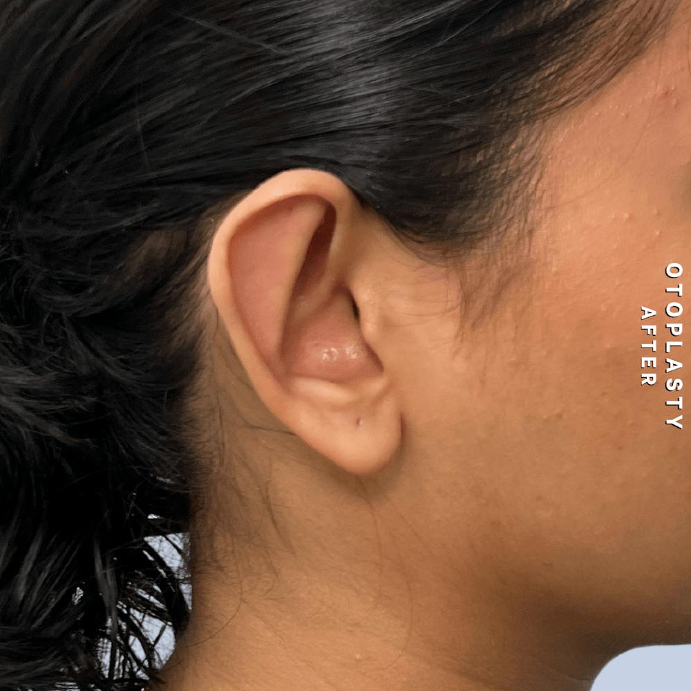 Ears Before & After Gallery - Patient 196133 - Image 6