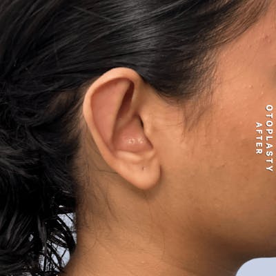 Ears Before & After Gallery - Patient 196133 - Image 6