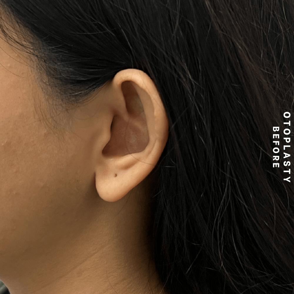 Ears Before & After Gallery - Patient 196133 - Image 7