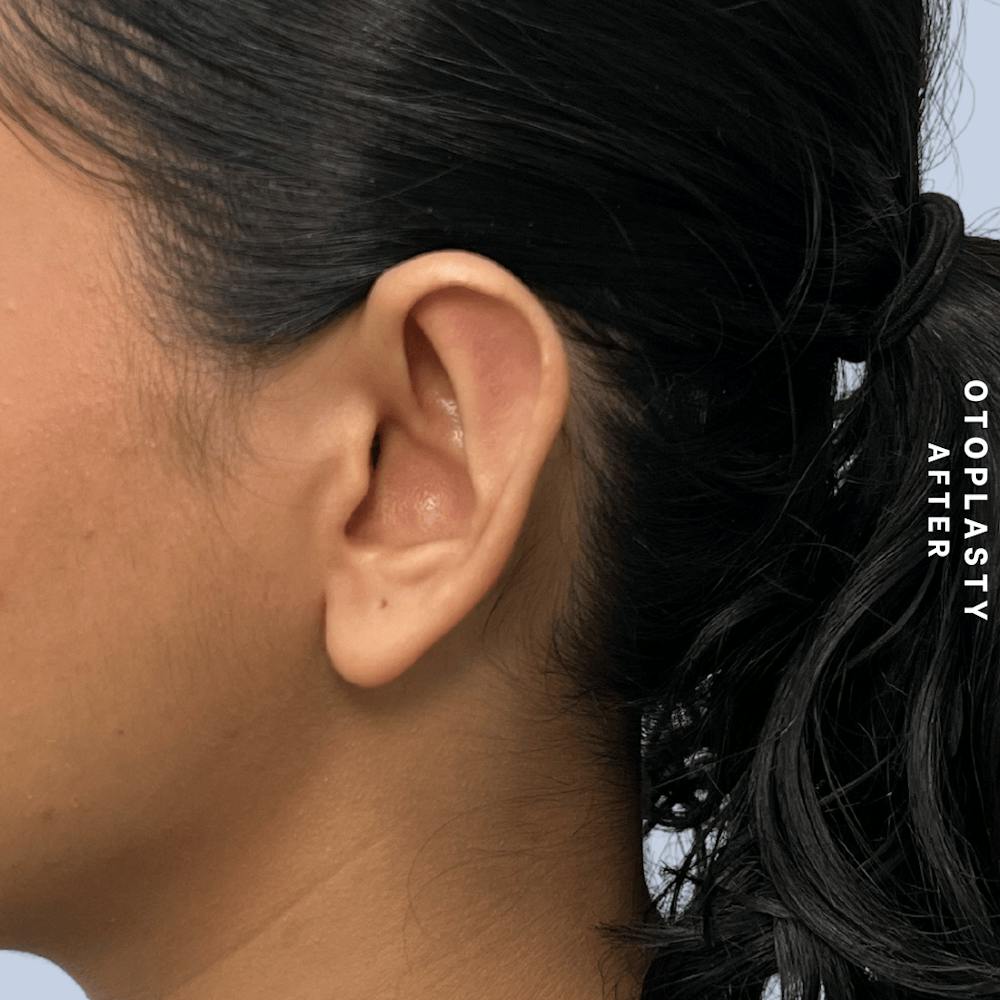 Ears Before & After Gallery - Patient 196133 - Image 8