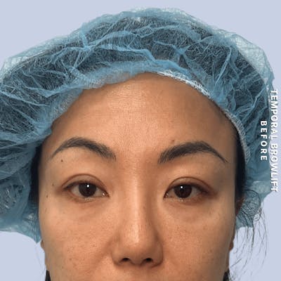 Eyes Before & After Gallery - Patient 288186 - Image 1