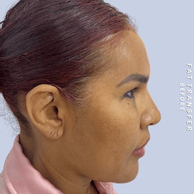 Other Before & After Gallery - Patient 277073 - Image 1