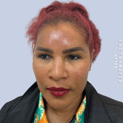 Other Before & After Gallery - Patient 277073 - Image 4