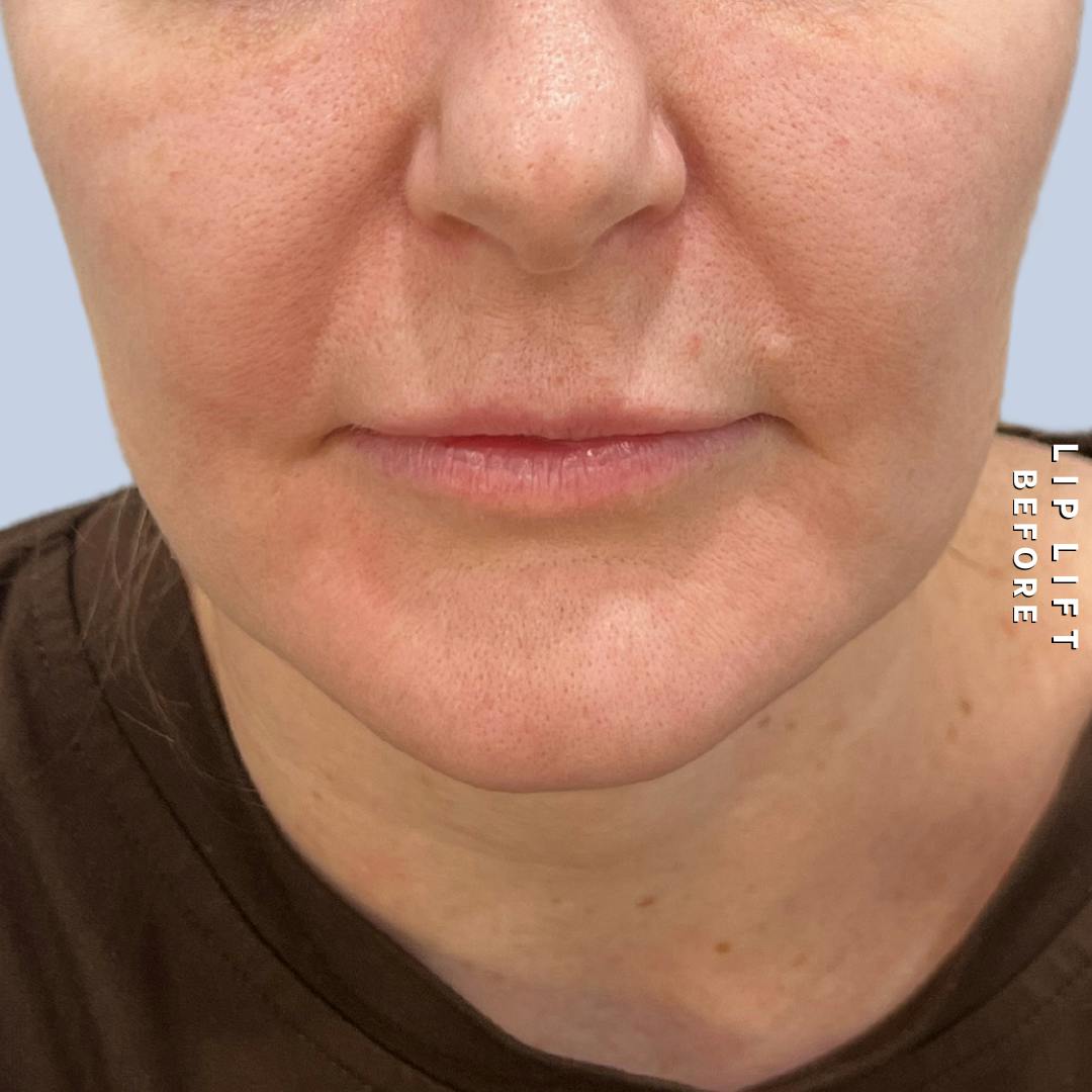 Lips Before & After Gallery - Patient 273451 - Image 1