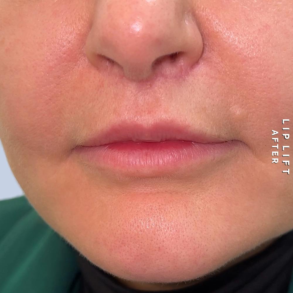 Lips Before & After Gallery - Patient 273451 - Image 2