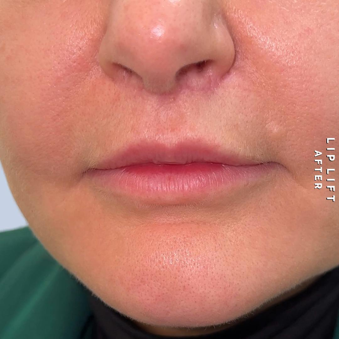 Lips Before & After Gallery - Patient 273451 - Image 2