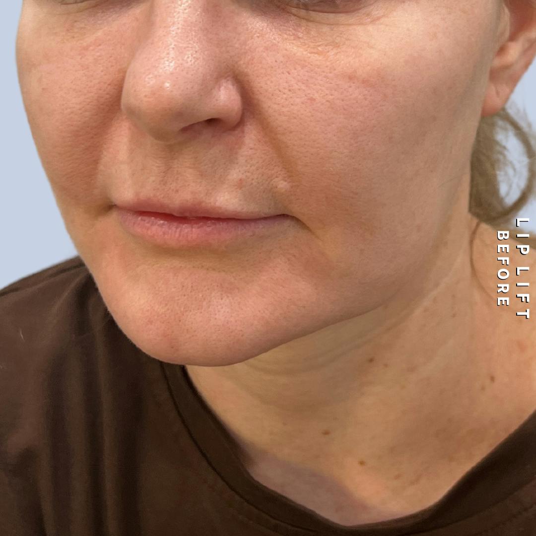 Lips Before & After Gallery - Patient 273451 - Image 3