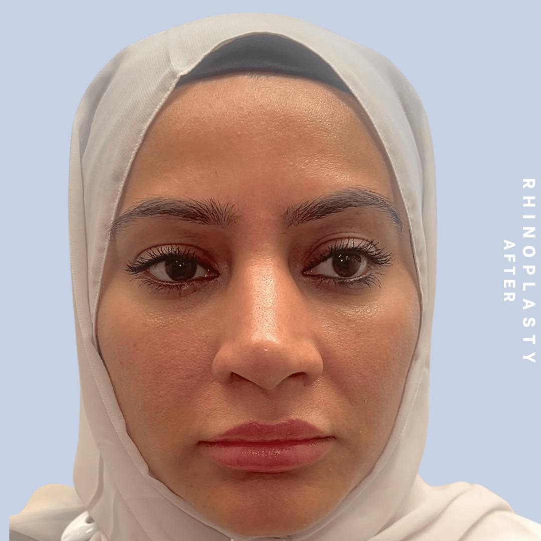 Nose Before & After Gallery - Patient 310117 - Image 10