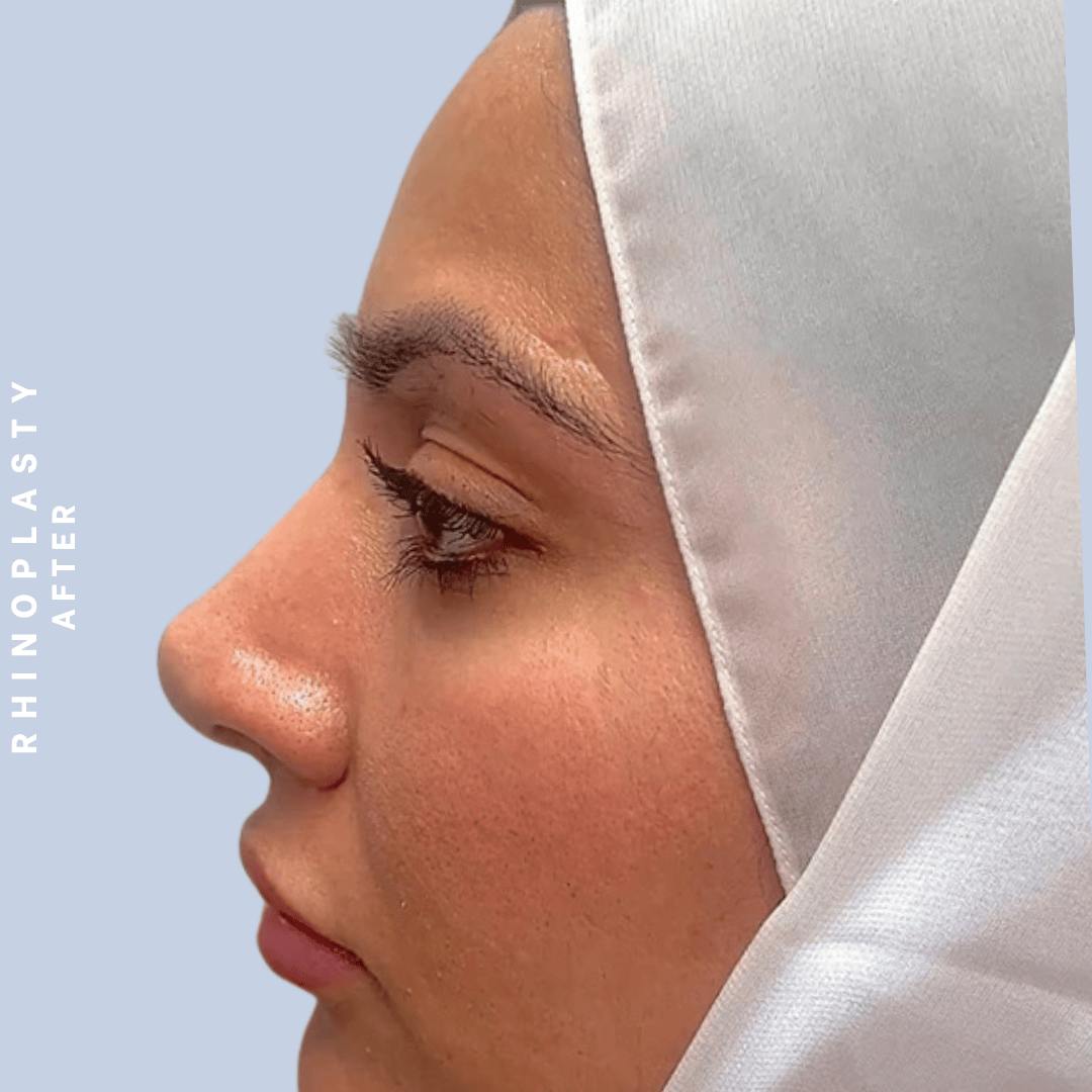 Nose Before & After Gallery - Patient 310117 - Image 2