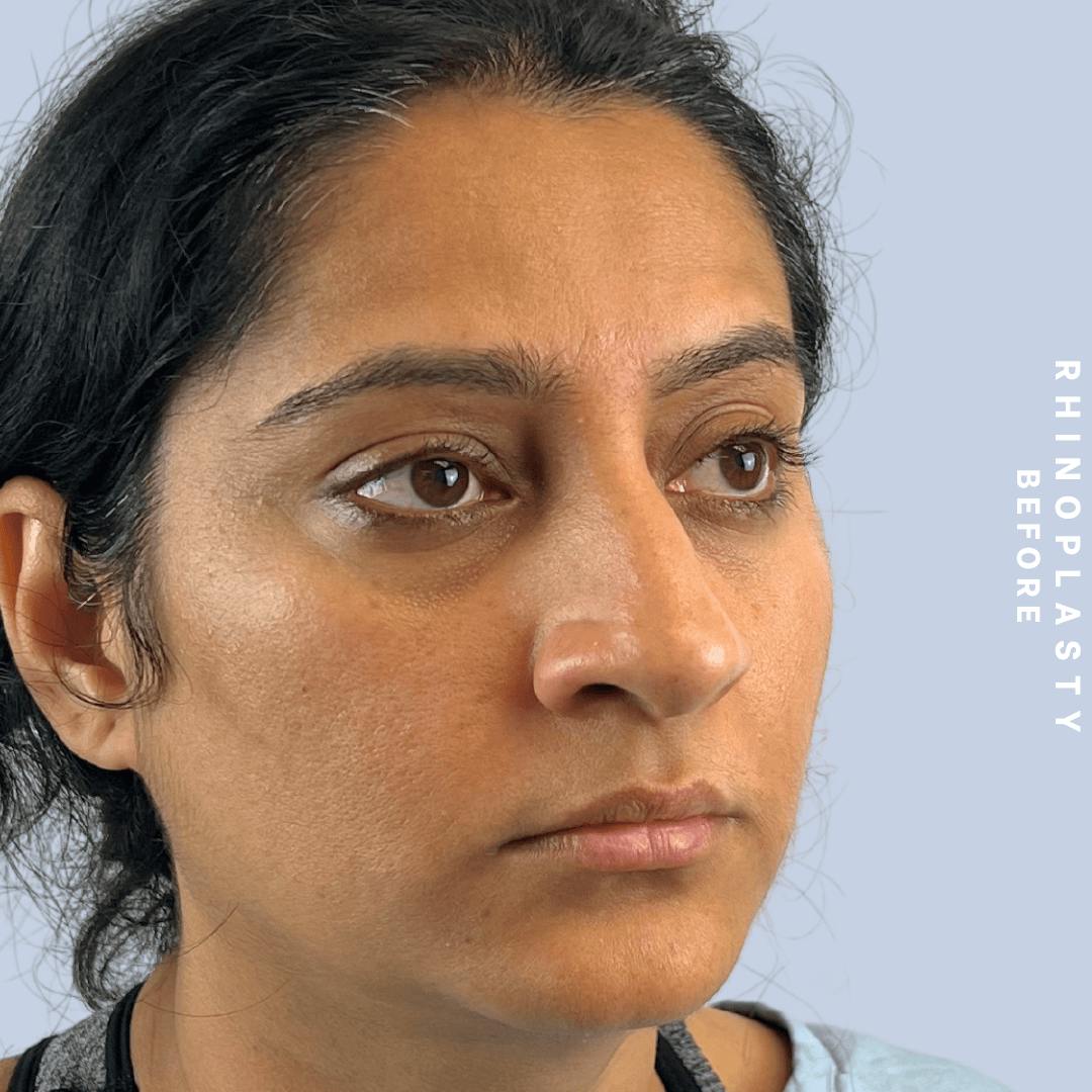 Nose Before & After Gallery - Patient 310117 - Image 7