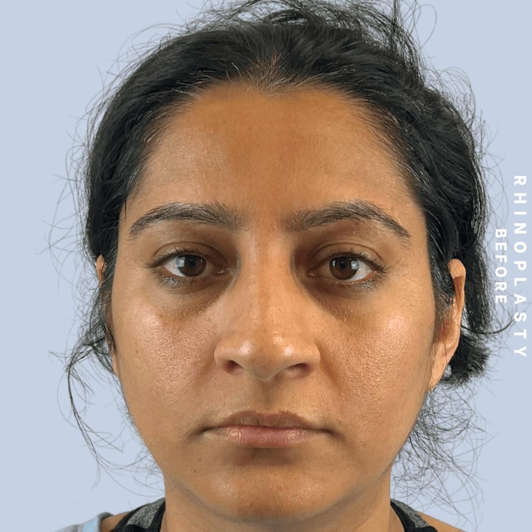 Nose Before & After Gallery - Patient 310117 - Image 9