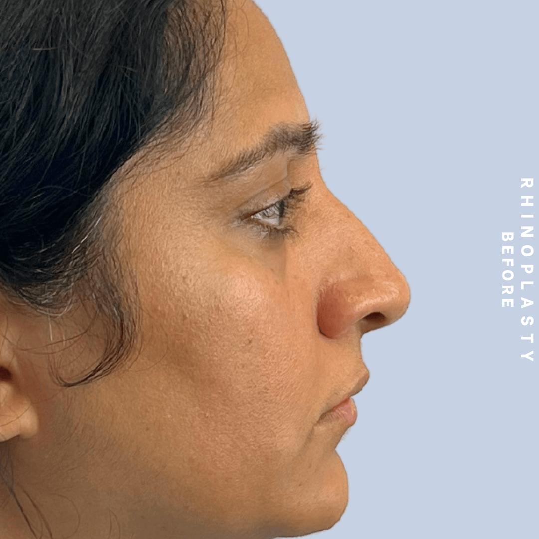 Nose Before & After Gallery - Patient 310117 - Image 3