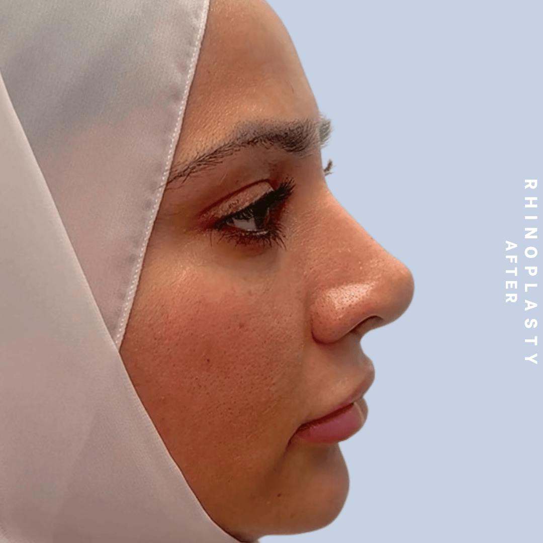 Nose Before & After Gallery - Patient 310117 - Image 4