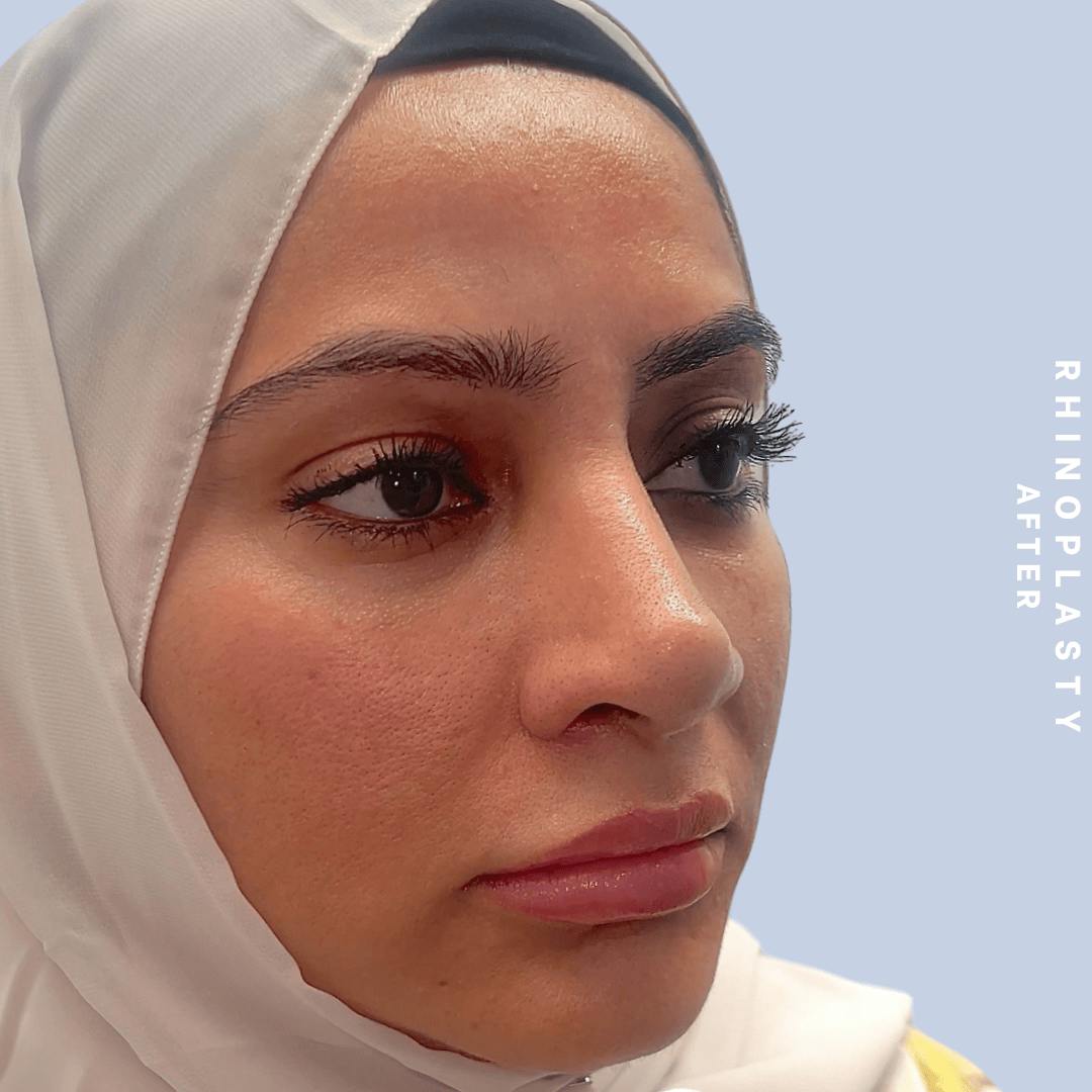 Nose Before & After Gallery - Patient 310117 - Image 8